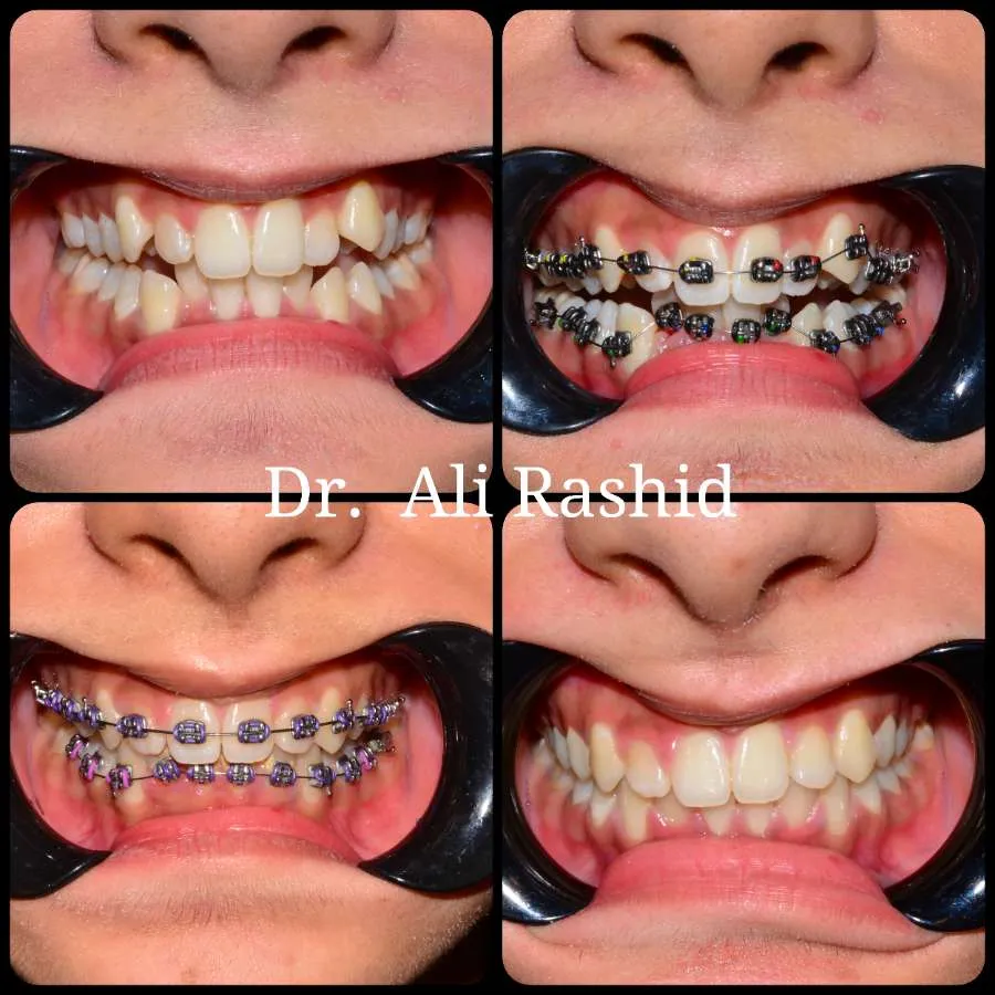 Braces before and after, Dr. Ali Rashid's Dental Clinic