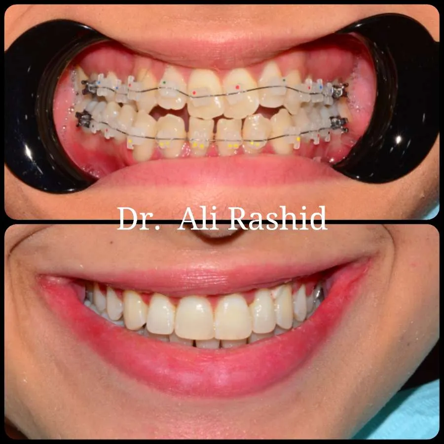 Braces before and after, Dr. Ali Rashid's Dental Clinic