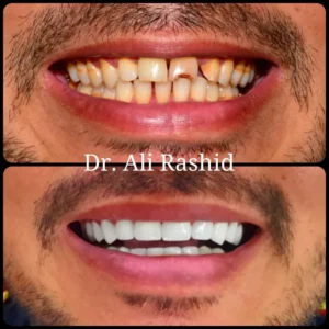Smile Makeover