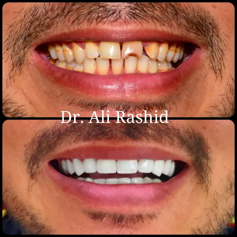 Smile makeover, before and after