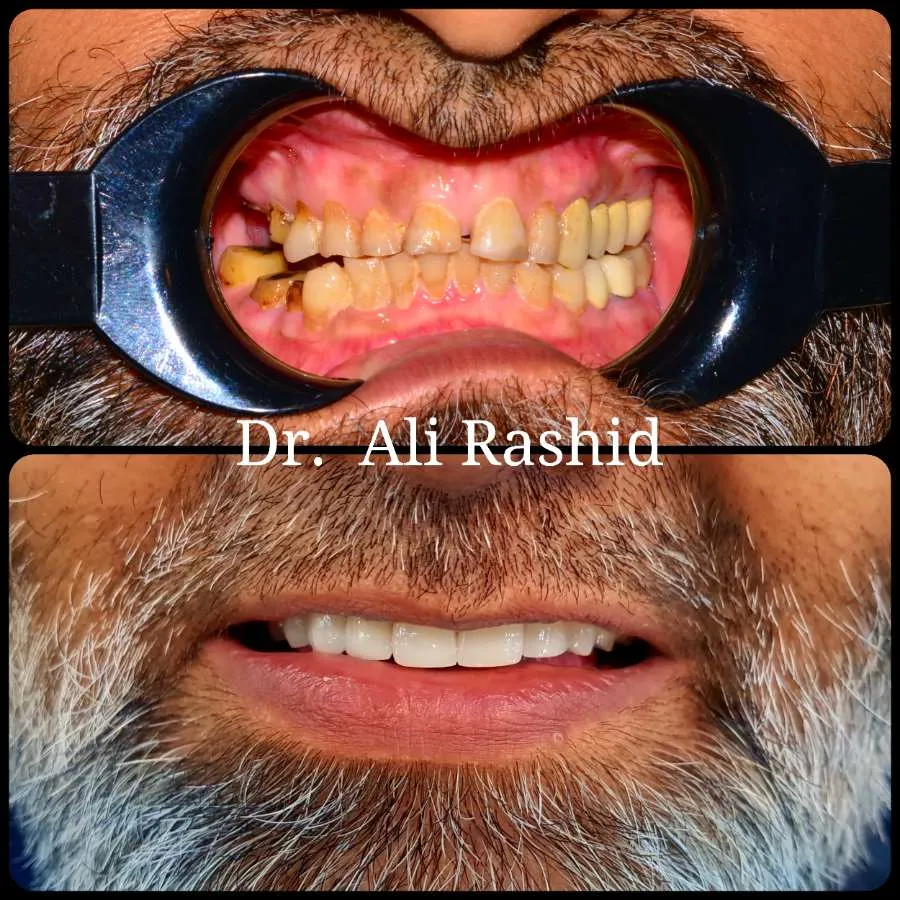 Smile makeovers before and after, Dr. Ali Rashid's Dental Clinic