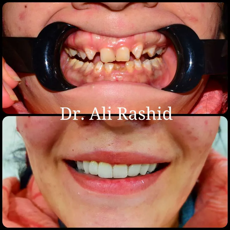 Smile makeovers before and after, Dr. Ali Rashid's Dental Clinic