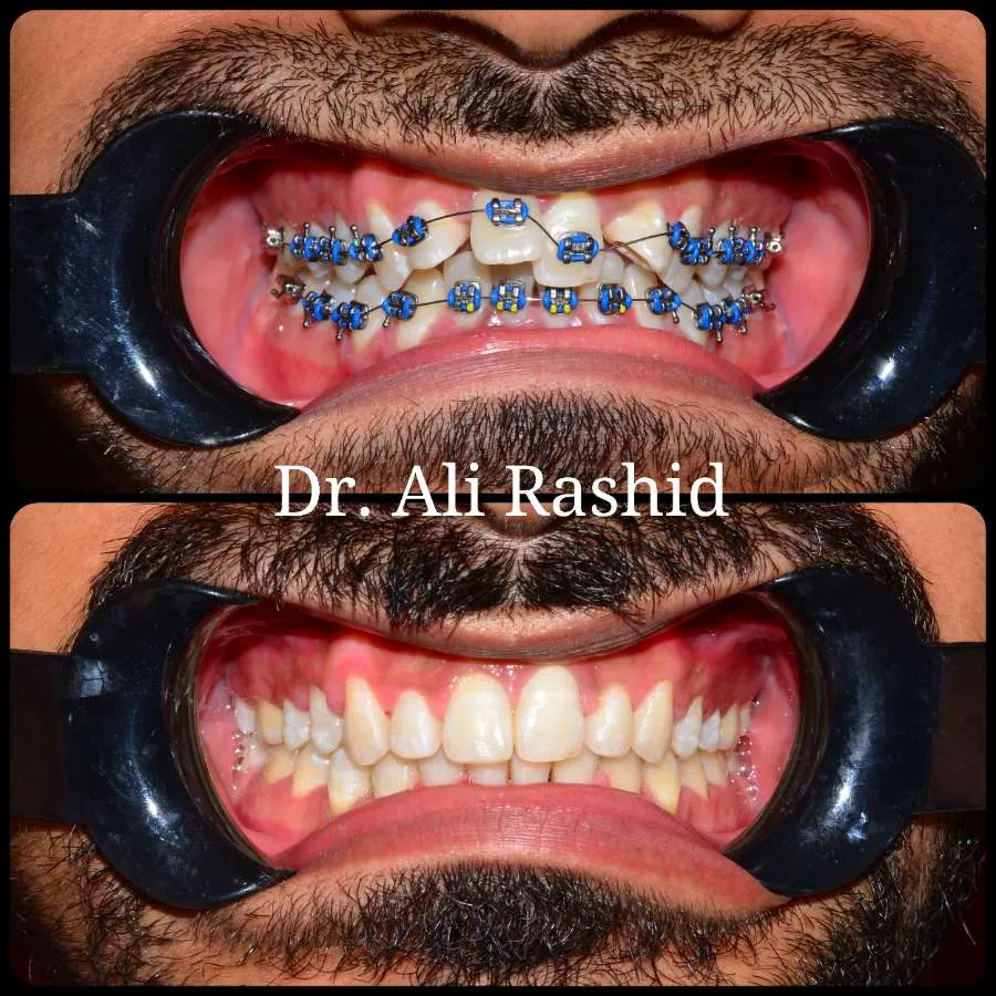 Braces before and after, Dr. Ali Rashid's Dental Clinic