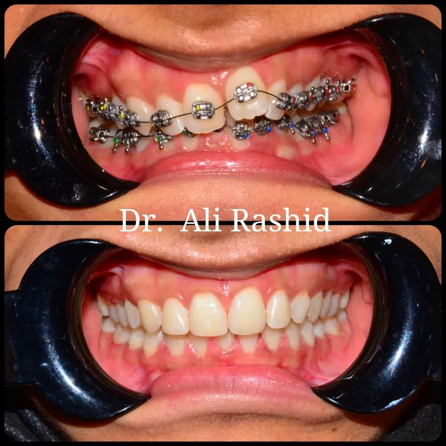 Braces before and after, Dr. Ali Rashid's Dental Clinic