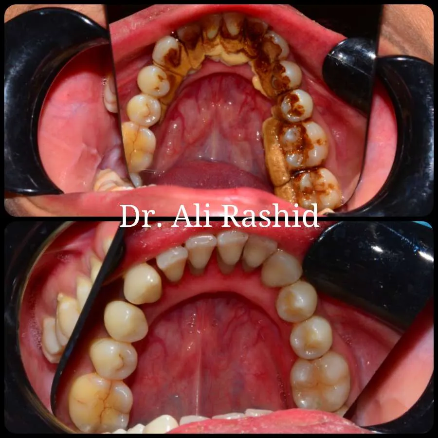 Scaling & polishing before and after, Dr. Ali Rashid's Dental Clinic
