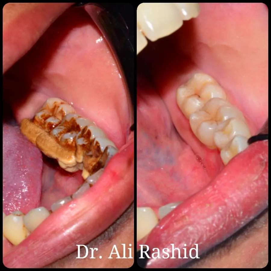 Scaling & polishing before and after, Dr. Ali Rashid's Dental Clinic