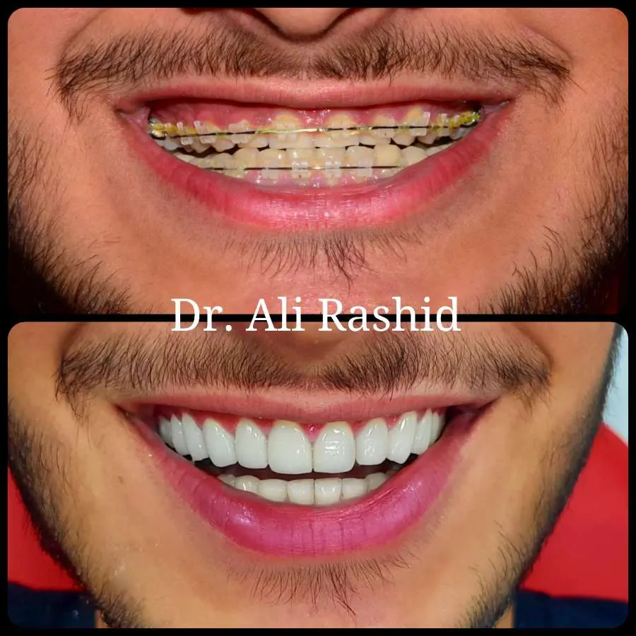 Braces treatment, before and after