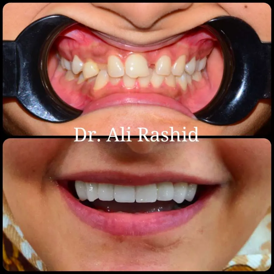 Smile makeovers before and after, Dr. Ali Rashid's Dental Clinic