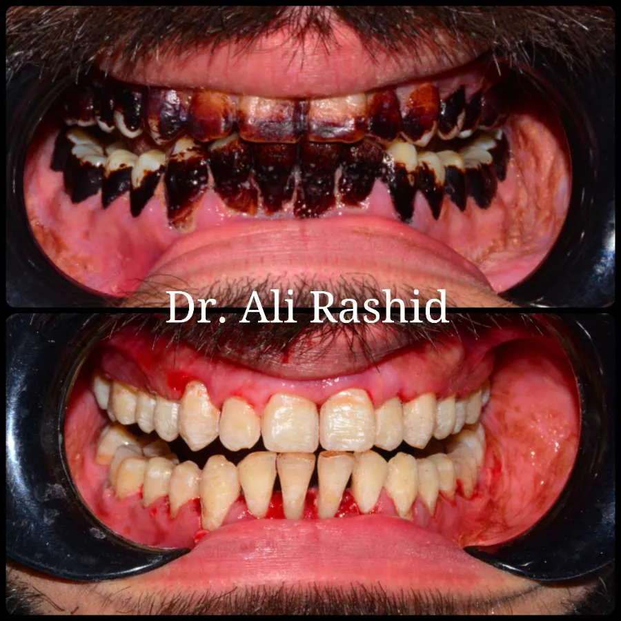 Scaling & polishing before and after, Dr. Ali Rashid's Dental Clinic