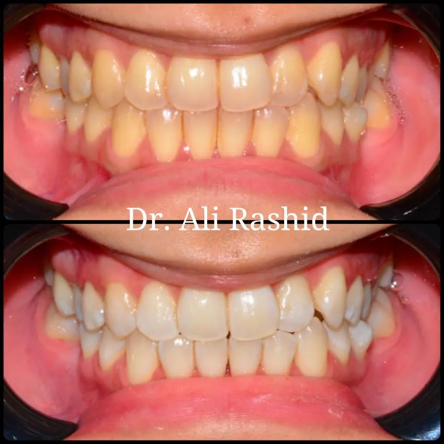 Teeth whitening before and after, Dr. Ali Rashid's Dental Clinic