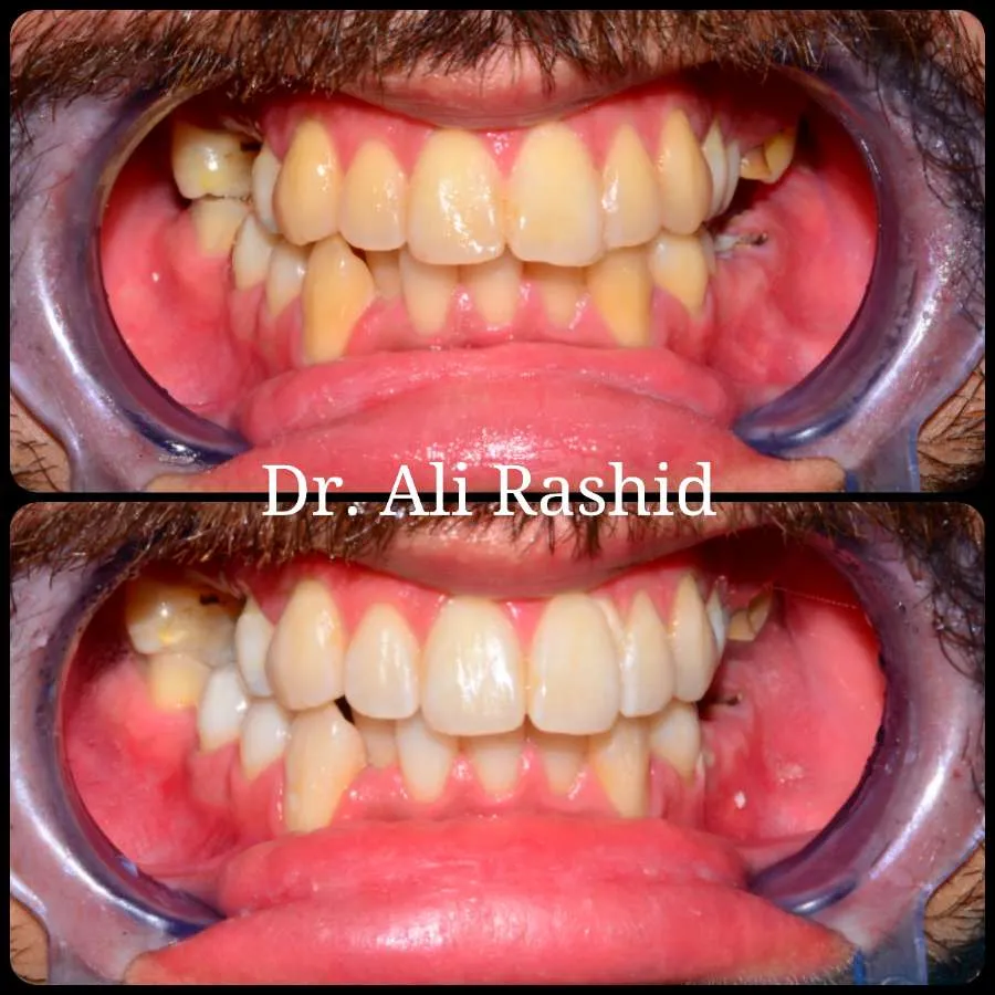 Teeth whitening before and after, Dr. Ali Rashid's Dental Clinic