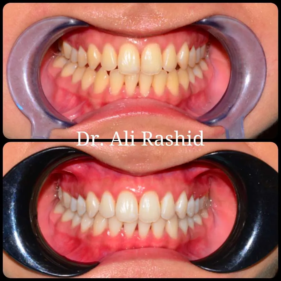 Teeth whitening before and after, Dr. Ali Rashid's Dental Clinic
