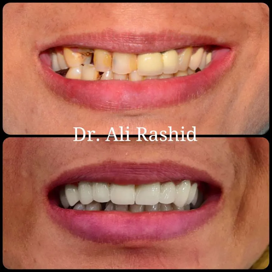 Zirconia crowns smile makeover, before and after